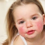 Allergy on the cheeks of a child