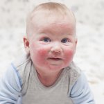 Атопический дерматит у детей: профилактика заболевания