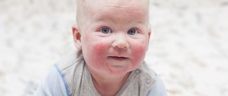 Атопический дерматит у детей: профилактика заболевания