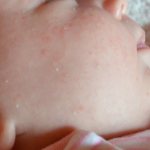 White pimples in a newborn