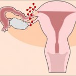 Pain during ectopic pregnancy