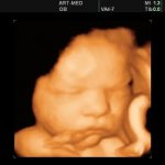 Photo of a three-dimensional ultrasound at 38 weeks of pregnancy
