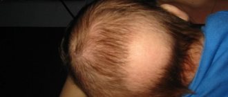 When does the bald spot on the back of a baby&#39;s head grow over?