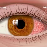 Conjunctivitis is an inflammatory process that occurs in the conjunctiva of the visual organs