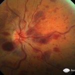 hemorrhage under the retina of the eye