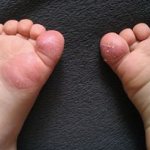 Mycosis on the leg, finger, foot in children