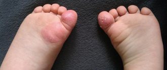 Mycosis on the leg, finger, foot in children