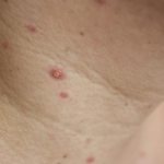 Is it possible to get chickenpox again?