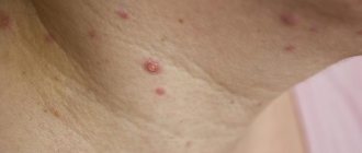 Is it possible to get chickenpox again?