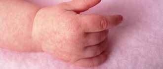 causes of marbled skin in babies