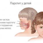mumps in children
