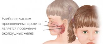 mumps in children