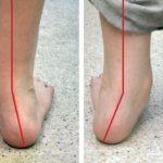 Flat valgus foot in children