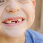 Eruption of molars in children