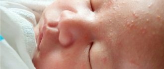 Pimples on a newborn&#39;s face with white heads, similar to mosquito bites. Causes, treatment, what to treat 