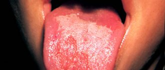 Spots on a child&#39;s tongue