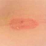 Pityriasis rosea - symptoms and treatment in Moscow