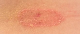 Pityriasis rosea - symptoms and treatment in Moscow