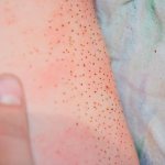 Tickler in children and newborns. What is it, photos, signs, how to remove it 