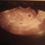 Ultrasound image of the ovum