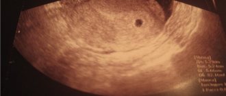 Ultrasound image of the ovum